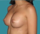 Mastoplastica additiva - Paziente di 27 anni, protesi Matrix di 335 seno destro, 320 seno sinistro - Dopo 1 mese