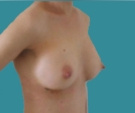Ricostruzione mammaria - Ricostruzione bilaterale del seno con protesi McGhan di 345 g per paziente di 34 anni - Dopo 