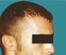Trapianto di capelli - Trapianto capelli, risultato dopo 2 interventi - Dopo 3 luni de la al 2-lea transplant