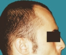 Trapianto di capelli - Trapianto capelli, risultato dopo 2 interventi - Prima